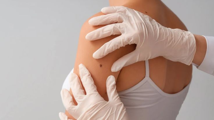 Verruca Treatment in Blackburn Using Swift Technology
