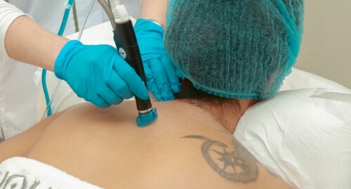 verruca removal Blackburn