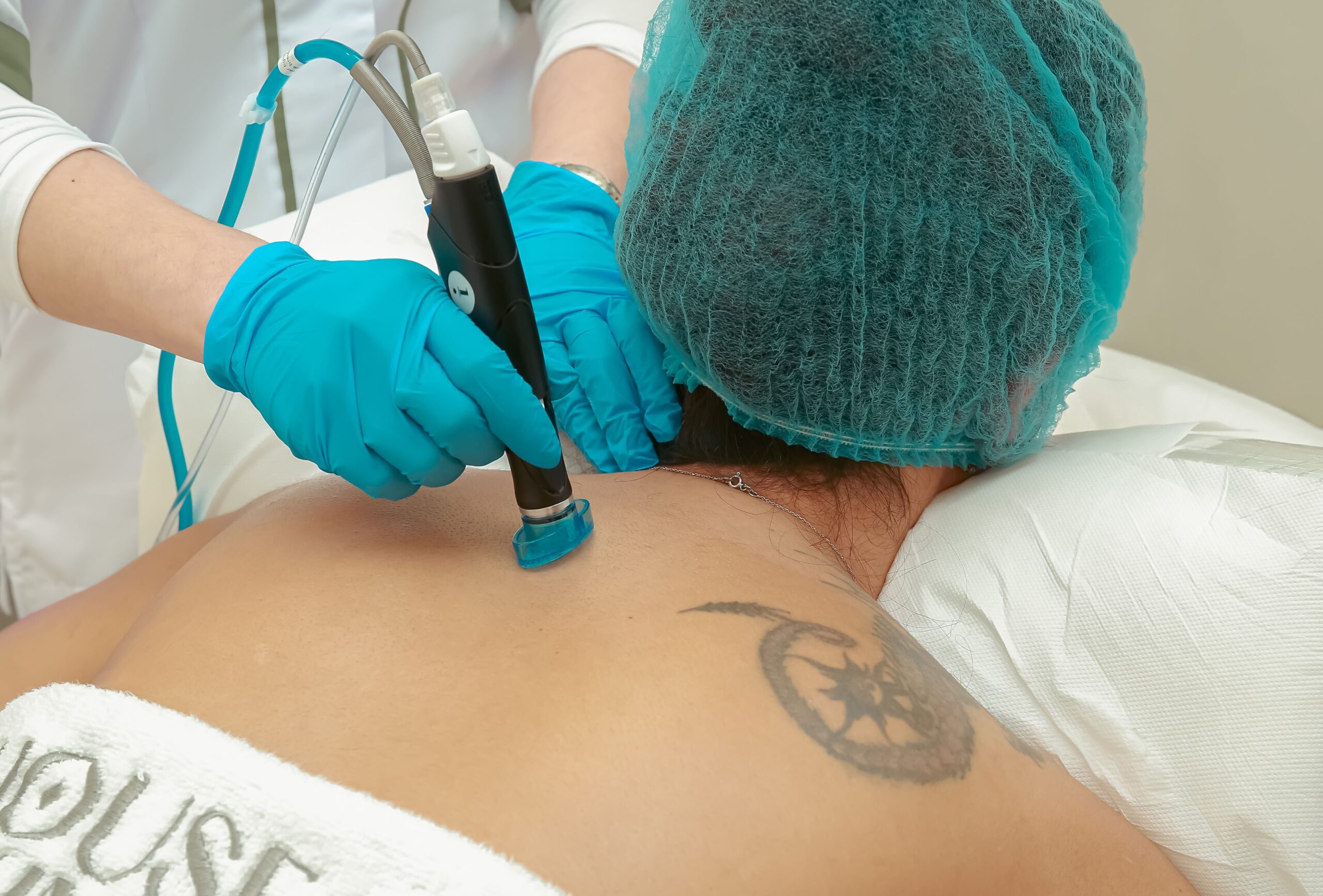 verruca removal Blackburn